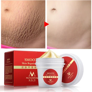 

MYQ Smooth Skin Cream For Stretch Marks Scar Removal To Maternity Skin Repair Body Cream Remove Scar Care Postpartum