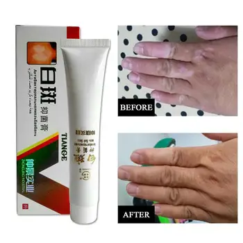 

Medical White Spot Disease Cream Pigment Melanin Promoting Liniment Skin Vitiligo Leukoplakia Disease Treatment plaster