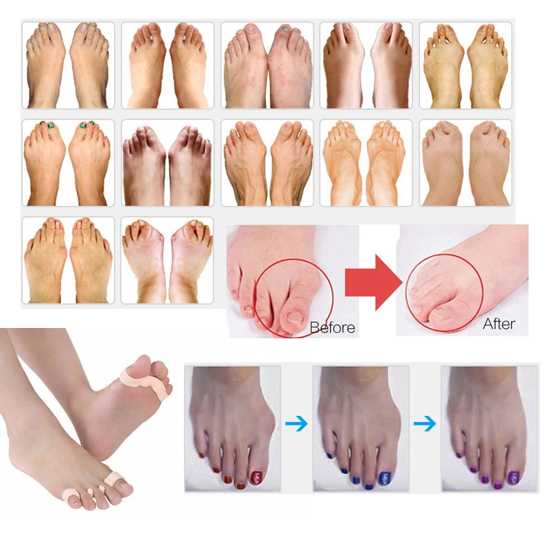 

1 pair Orthotic Toe Separator Straightener Bunion Silicone Flexible Valgus Splint Corrector ingrown toenail tool