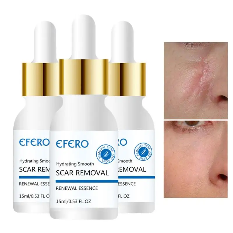 Efero Scar Remove Essence Acne Treatment Blackhead Removal Anti Acne