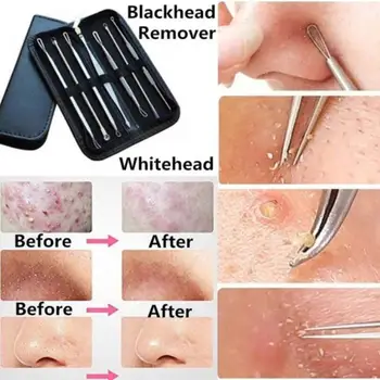 

3 4 5 8 Pcs Stainless Steel Blackhead Remover Tool Kit Face Massage Whitehead Pimple Spot Comedone Acne Extractor Face Massager