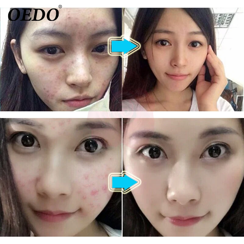 Plant Extraction Repair Acne Cream Ginseng Scutellariae Extract Face Care Ance Treatment Skin Care Facial Cream Whitening g Facial Self Tanners Bronzers Aliexpress