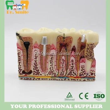 

Caries Tooth Model Dentist Patient Communication Anatomy Model Dentistry Rich Details Teaching Aids Equipment
