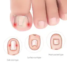 

Useful Toenail Fixer Eco-friendly Iron Ingrown Toenail Correction Tool Toe Pedicure Ingrown Toenail 1 Set