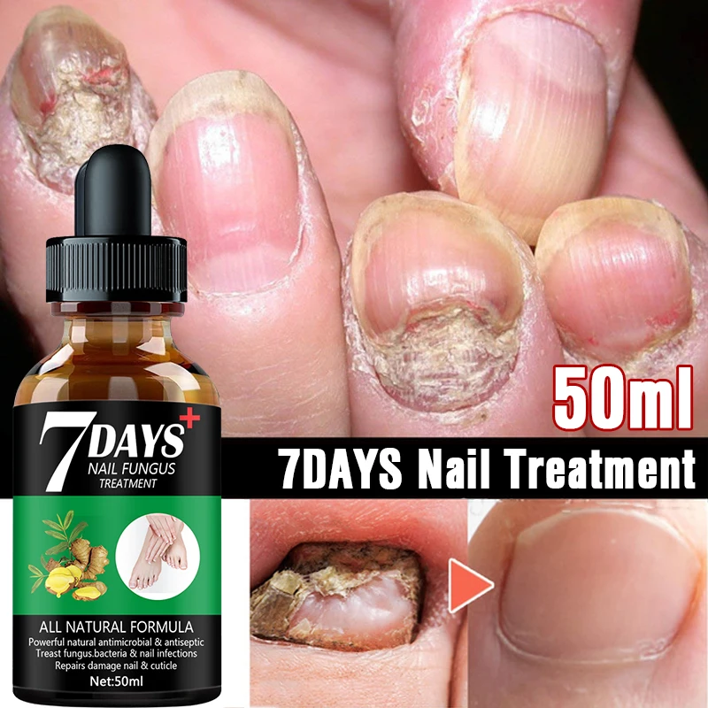 Nail Fungus Treatment Essence Serum Care Hand and Foot Care Removal Repair Gel Anti-infective Paronychia Onychomycosis