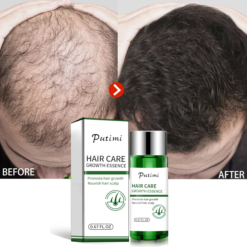 Putimi продукты против выпадения волос для ухода за волосами натуральная эссенция имбиря Сыворотка для роста волос быстро растущая эссенция для роста волос