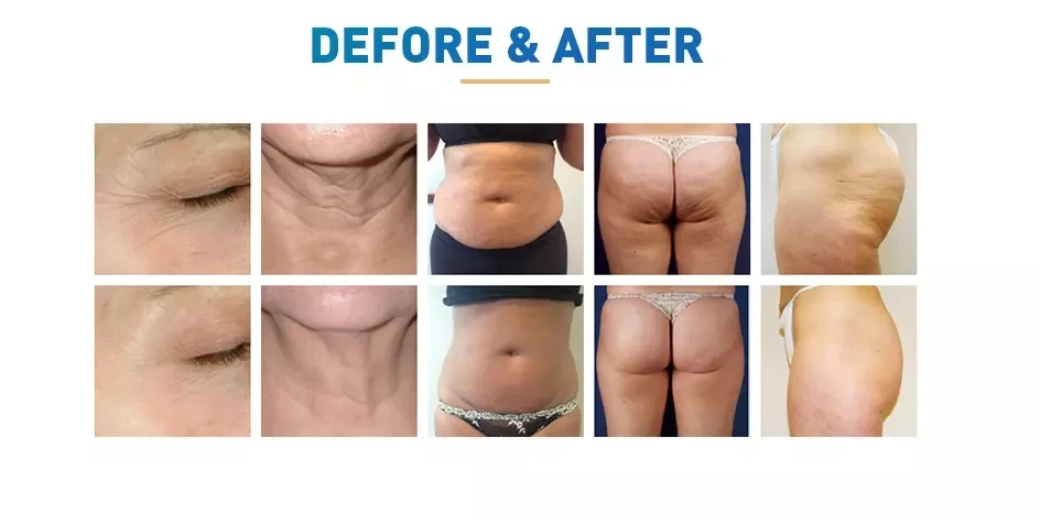 кавитация живота отзывы