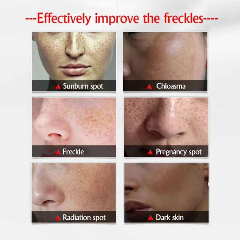 30ml Whitening Face Cream Remove Freckle Cream Beauty Face Skin Care