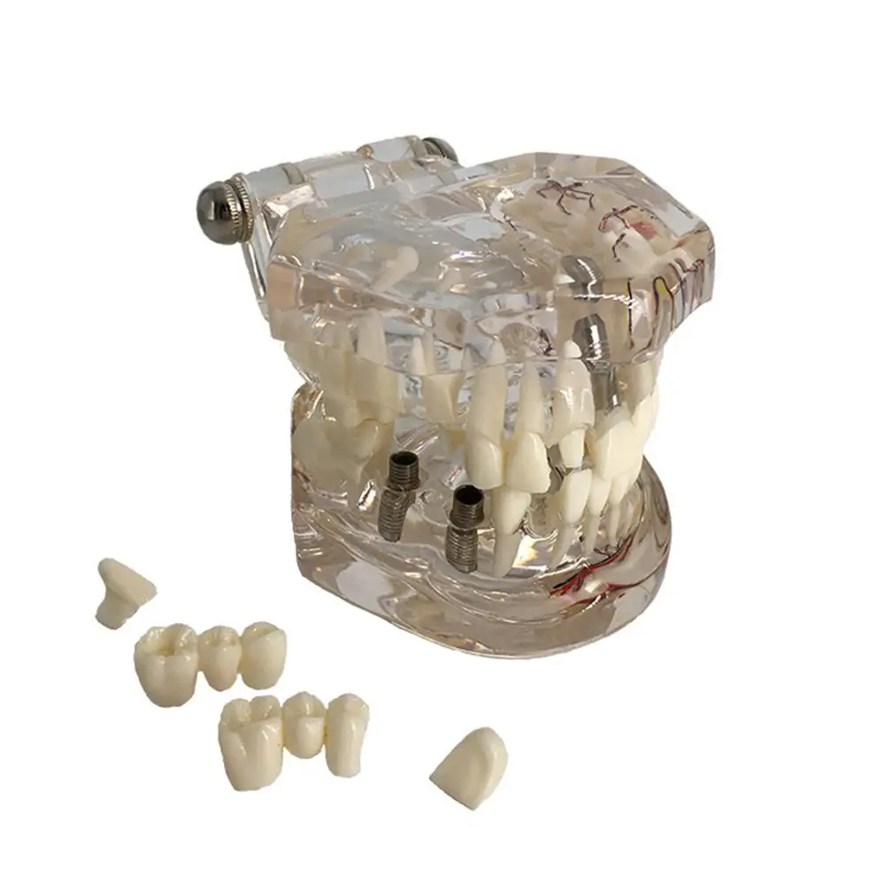 Стоматологическая модель имплантата зубов с реставрационным мостом зубной Стоматолог для медицинских исследований