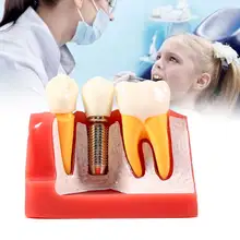 

1 Set Resin Dental Student Demonstration Tooth Model Implant Analysis Crown Bridge For Dentist Oral Medical Product Equipment