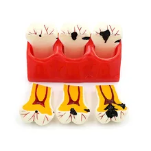Modèle de dent carie dentaire, modèle de dent de carie dentaire, modèle de dent de dégradation, modèle de dent de dentiste, outils d'enseignement