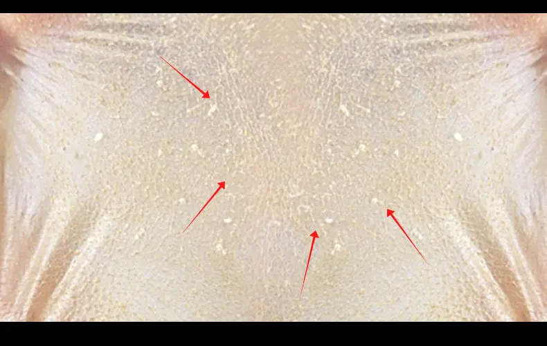 rose-blackhead-removal_09