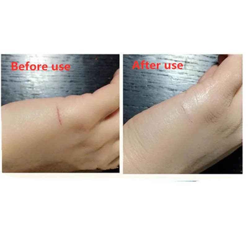 

Liquid band aid, sterilization and disinfection, hemostatic adhesive, waterproof, quick drying, wound / scratch healing.
