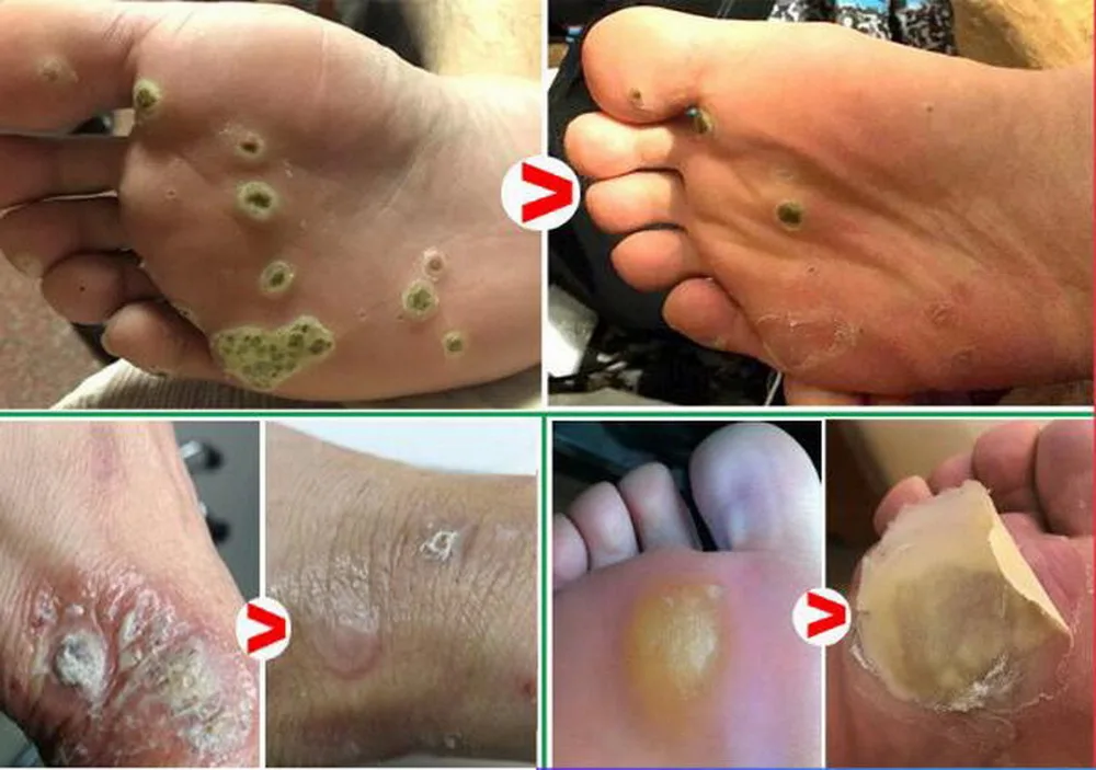 3 мл стилус для кожи этикетки электронная ручка удаления мозолей на ногах