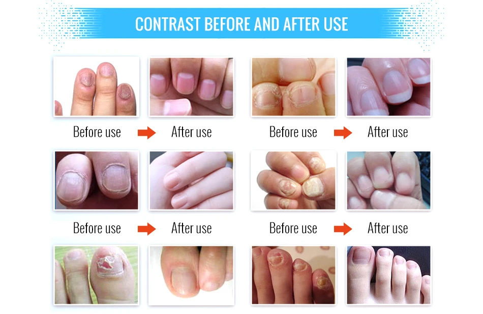 OMYLADY новая эссенция для восстановления ногтей, сыворотка для лечения грибков ногтей, для удаления онихомикоза, для ног, Питательная, для осветления рук, для ухода за кожей ног