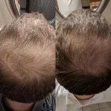 Esencia De rápido crecimiento De pelo, productos Para la pérdida del cabello, Fibras Para el crecimiento del cabello, champú, crema De tratamiento Para el cuidado del cabello