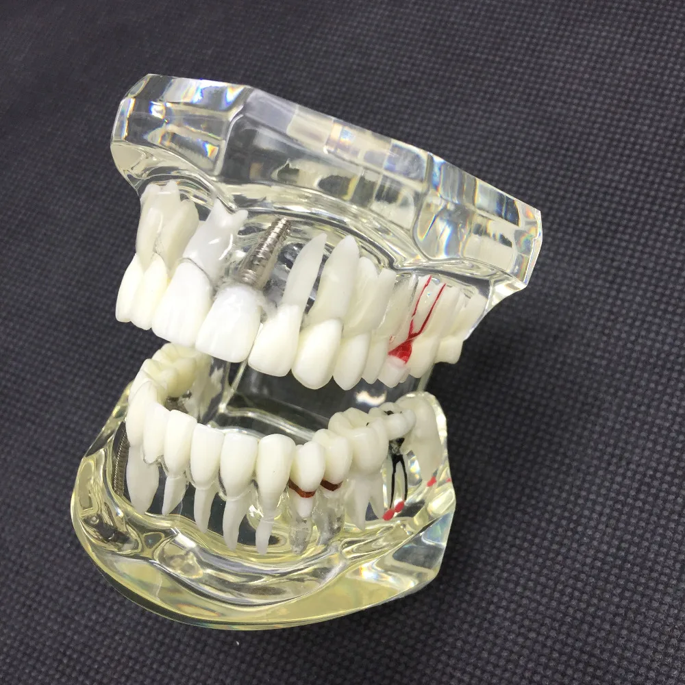

Dental Study Tooth model Transparent Adult Pathological Teeth Model Fit for Adult Teaching Study