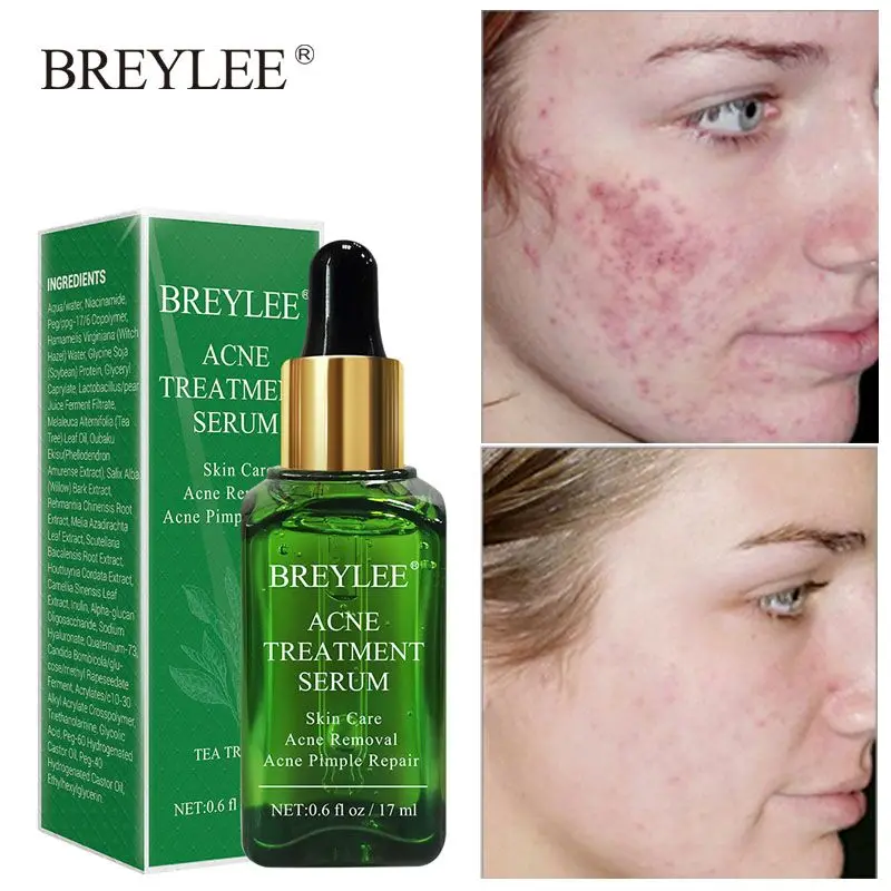 

BREYLEE Acne Treatment Face Serum Tea Tree Fades Acne Marks Remover Scar Shrink Pores Whitening Moisturizing Facial Essence 17ml