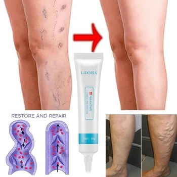 

Medical Varicose Veins Cream Promote Blood Circulation Relief Phlebitis Vasculitis Varicose Veins Treatment Ointment Health Care