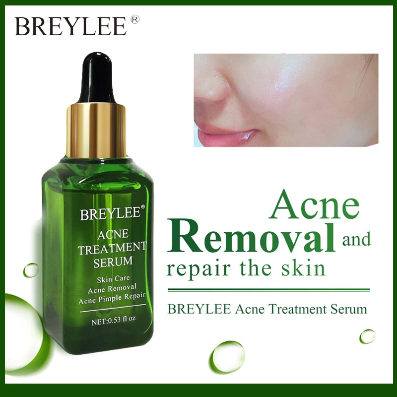 serum facial anti acne