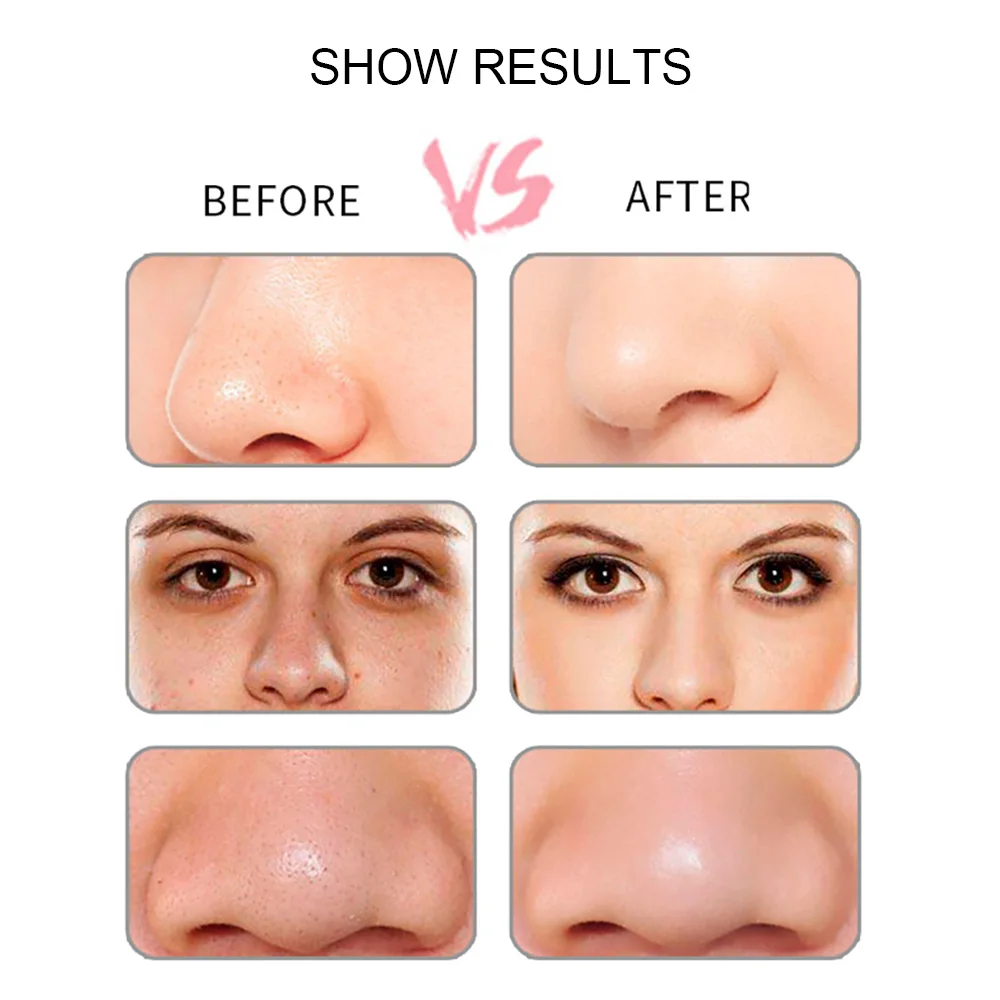 Acne Pimple Removal Blackhead Cleaner Facial Cleaning Machine Pore Cleaner Fast Effective Vacuum Suction ABS for Vibration