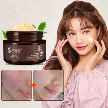 

Herbal Acne Treatment Cream for Face Pimple Acne Scar Blackheads Removal Shrink Pores Facial Whitening Oil-Control Skin Care