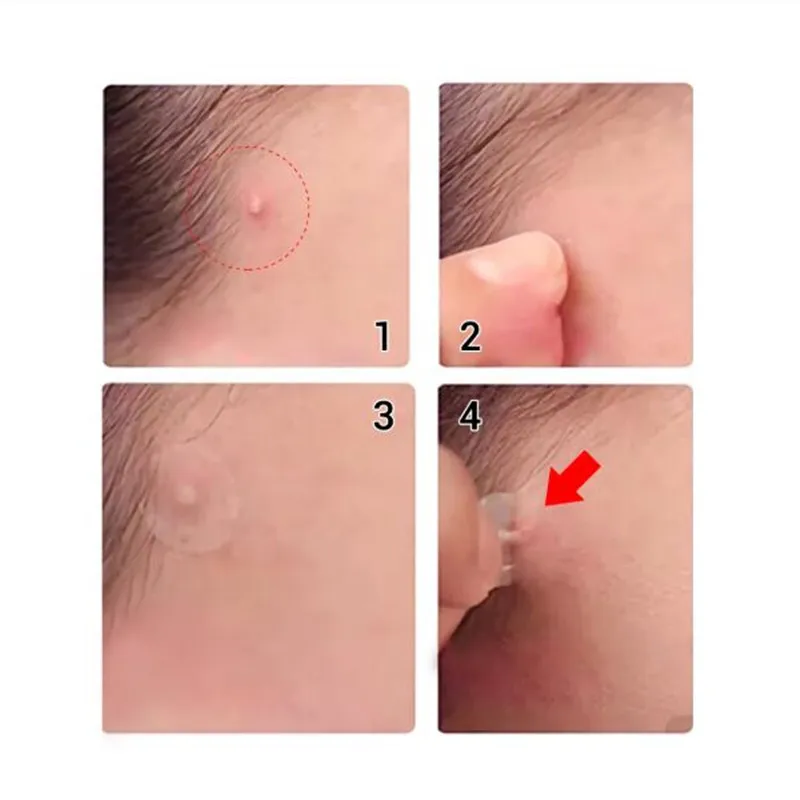 28Pcs LANBENA Acne Pimple Patch Face Mask For Face Acne Pimple Blemish Spot Treatment Invisible Acne 2