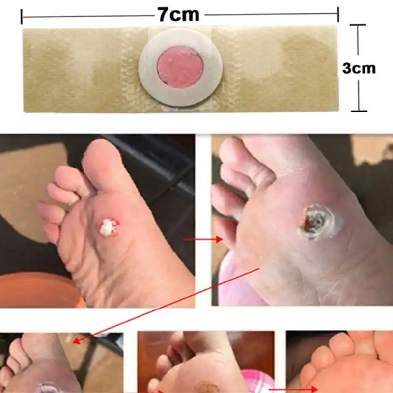 corn under foot removal