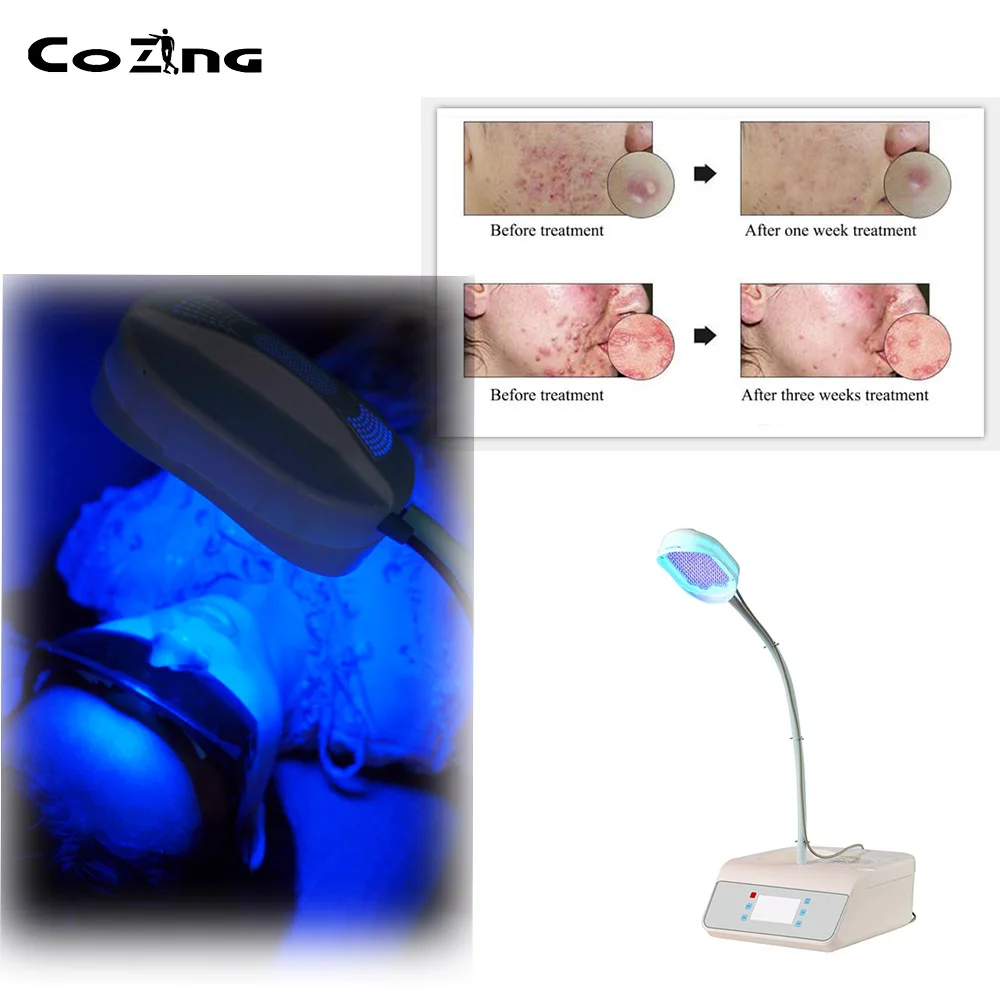  Red And Blue Led Light Phototherapy For Skin Acne Treatment - 4000194843540