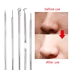 Blackhead Remover Needles Tool Squeezing Acne Extractor Spoon Tools Face Care Comedone Pore Cleaner Black Dot Pimple Treatment ► Photo 2/6