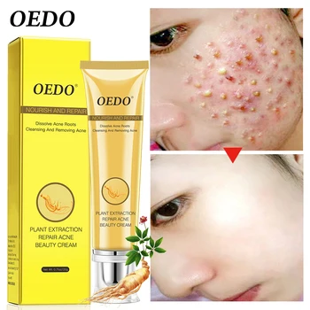 

Acne Treatment Blackhead Remova Anti Acne Cream Oil Control Shrink Pores Acne Scar Remove Face Care Whitening