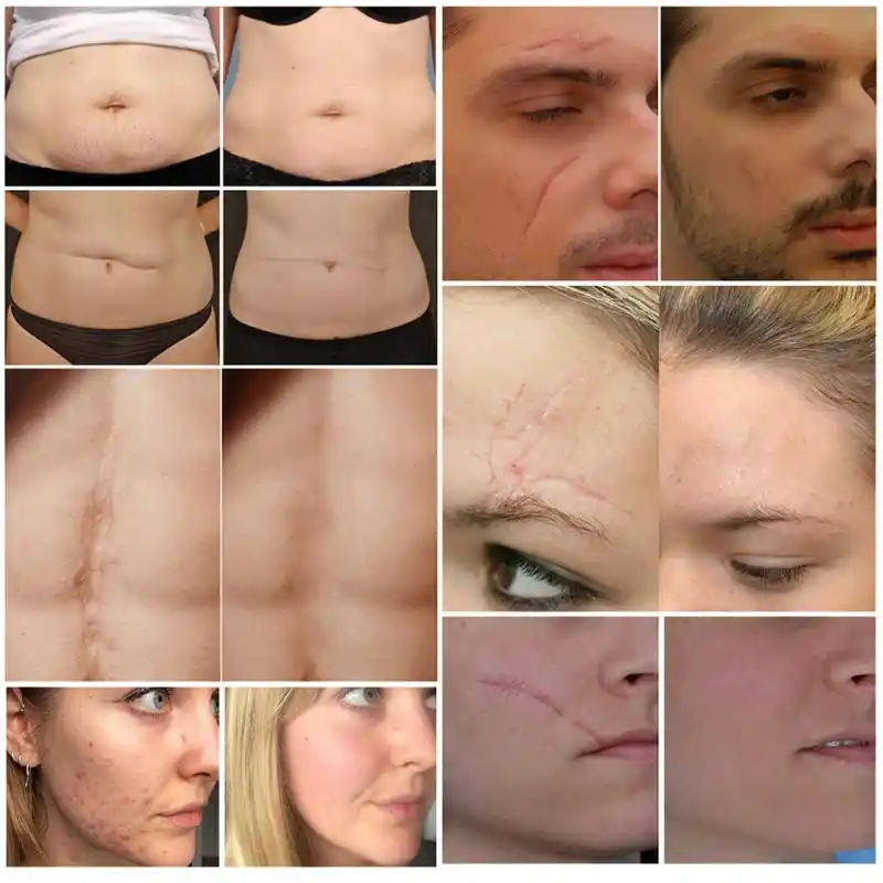 eelhoe scar removal cream