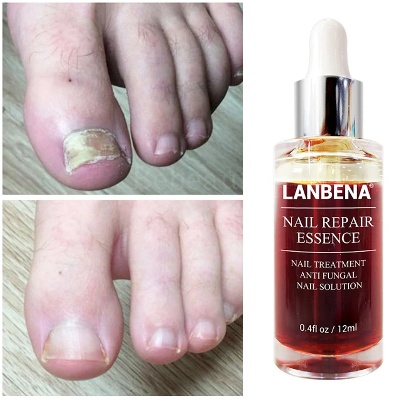 Эссенция Lanbena для восстановления ногтей средство от грибка лечение Lambena Antihongos на