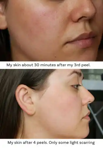 glycolic acid good for acne scars