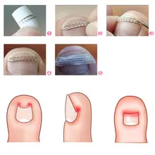 Инструмент для коррекции вросших ногтей Корректор для педикюра 23GF