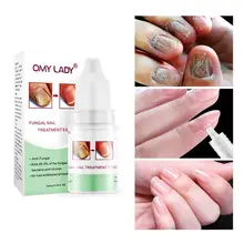 Лечение ногтей от грибка эссенция травы противогрибковый Onychomycosis Paronychia крем для ногтей уход за пальцами