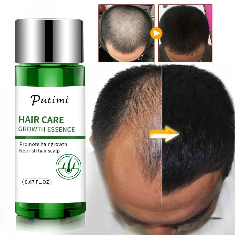 En venta Aceites esenciales para el crecimiento del cabello de jengibre, esencia para estimular el crecimiento del cabello, previene la pérdida de pelo para calvicie, suero para el cabello reparador, cuidado para el pelo dañado 33mj6YWezQ6