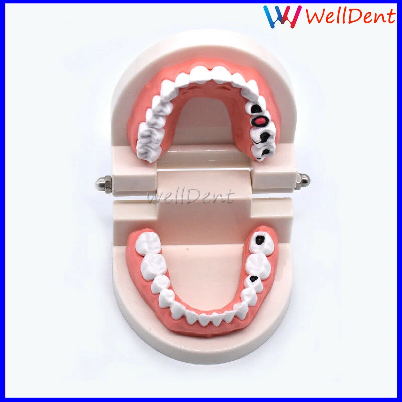 Dental-Study-Teaching-Teeth-Model-Caries-Tooth-Care