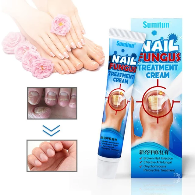 Sumifun 20g Nail Fungus Treatments Cream Anti Fungal Foot Toe Nails Repair  Anti-infection Onychomycosis Paronychia Ointment - Plaster - AliExpress