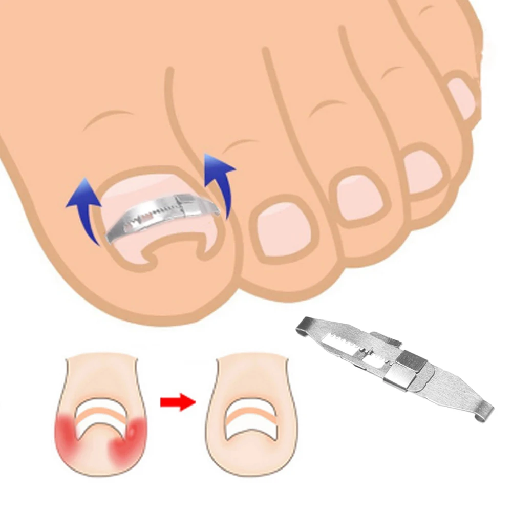 1Set Ingrown Toe Nail Correction Tool Toenail Straightening Correctors Patch Tool Kit Nail Repairer Orthosis Beauty Tools