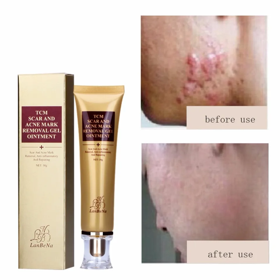 fast acne scar removal cream