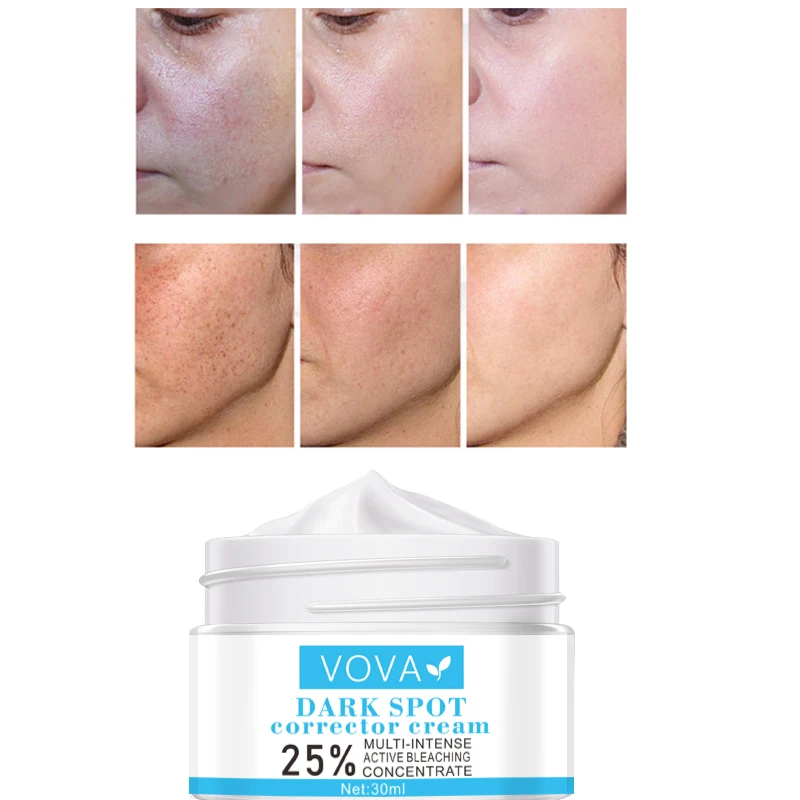 VOVA crema blanqueadora eficaz para pecas, elimina el Melasma, las