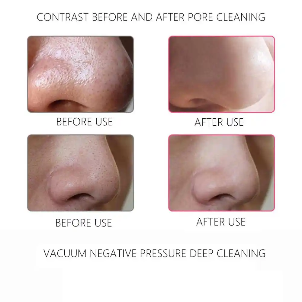 vacuum face pore cleaner