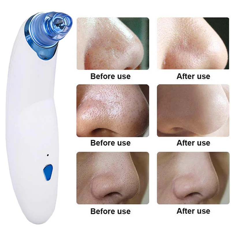 Electronic Blackhead Acne Remover Vacuum Dermabrasion Face Pore Cleaner Machine LDO99