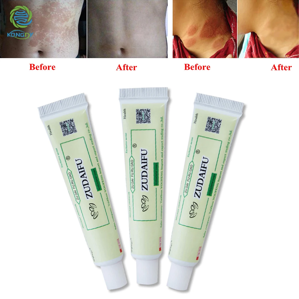 ZUDAIFU 2 шт крем от псориаза снять псориаз мазь дерматит экзема зуд кожи лечение заболеваний Китайский травяной крем