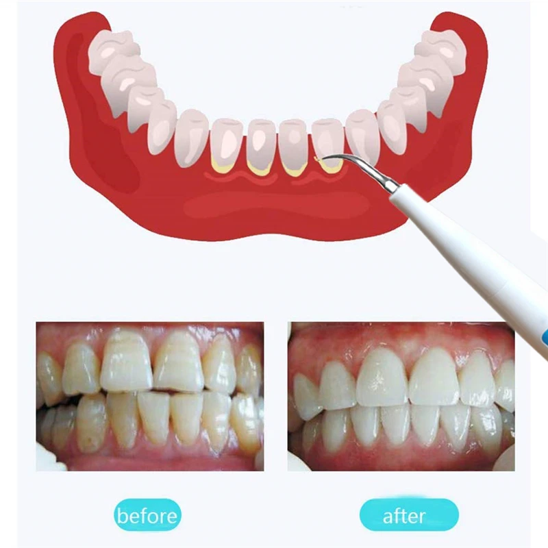 Ceny Przebarwienia na zębach Remover ultradźwiękowe wibracje wysokiej częstotliwości bezprzewodowe Dental bezwodne narzędzia do wybielania kamienia nazębnego