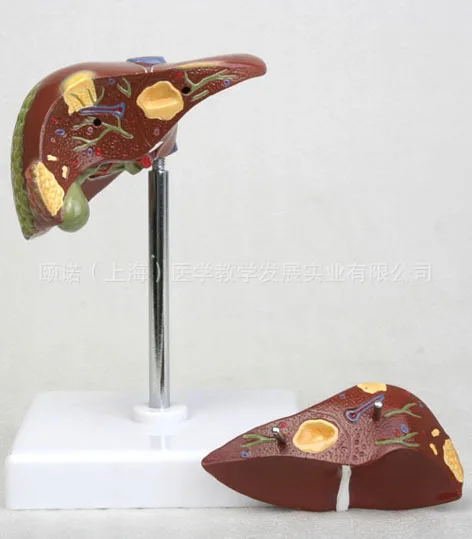 Модель лечения гепатита В жировой печень цирроз пищевая медицина модель Hepatobiliary
