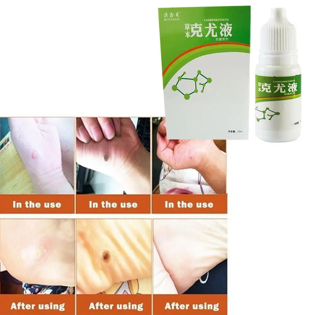 

Genital Warts Treatment Papillomas Removal Warts Fluid Remedy From 10Ml Tags Anti Skin Removal Moles Wart Remover Against Q3T3