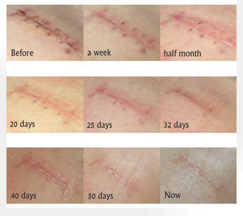 scar-ance-removal-gel_10