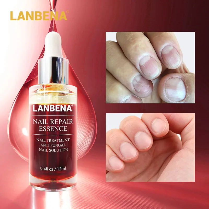 LANBENA, восстанавливающая эссенция для ногтей-сыворотка, лечение грибков ногтей, удаление онихомикоза, уход за зубами носа, осветление, уход за руками и ногами